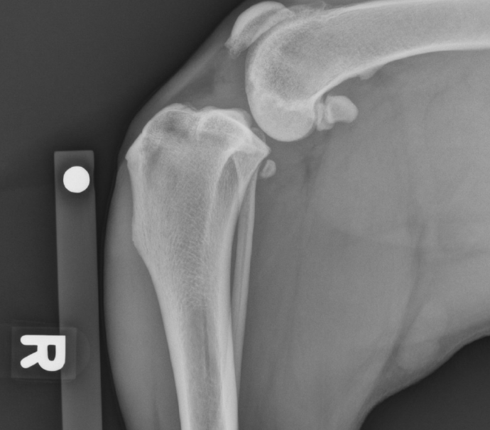 Unstable knee joint filled with fluid