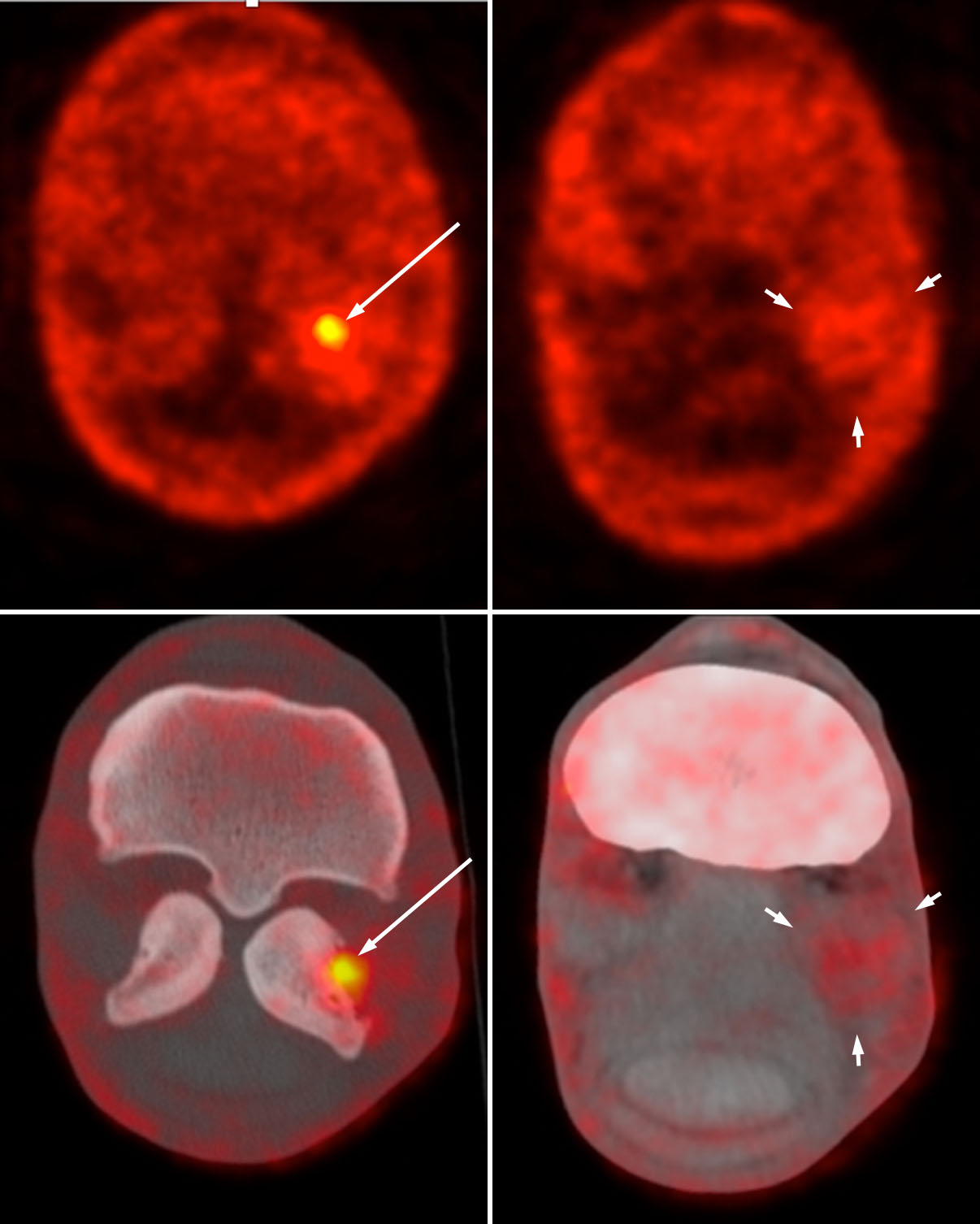 NaF PET and fused PET CT transverse images of the fetlock of a 6-year-old Warmblood horse.
