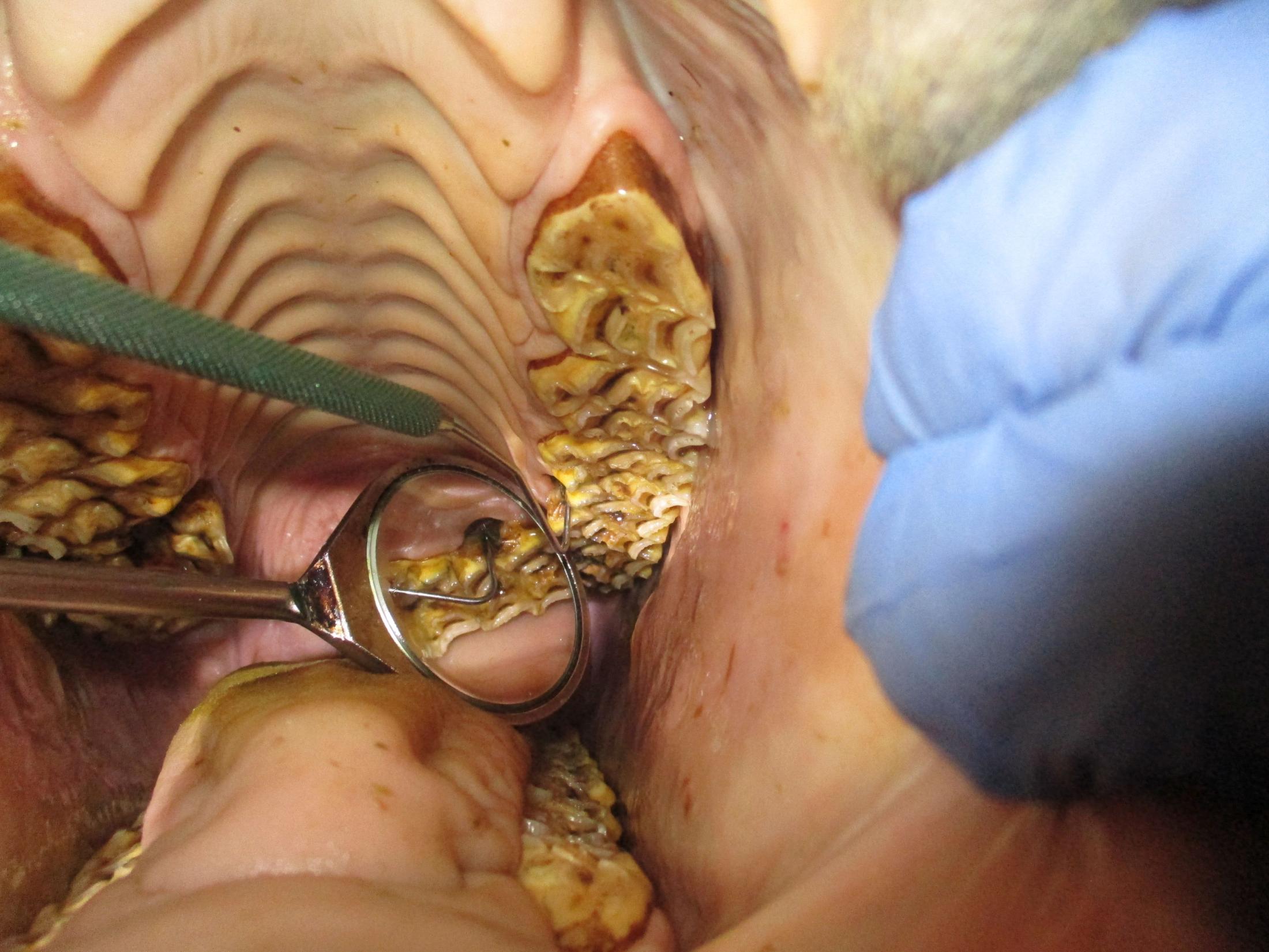 deep periodontal pocket