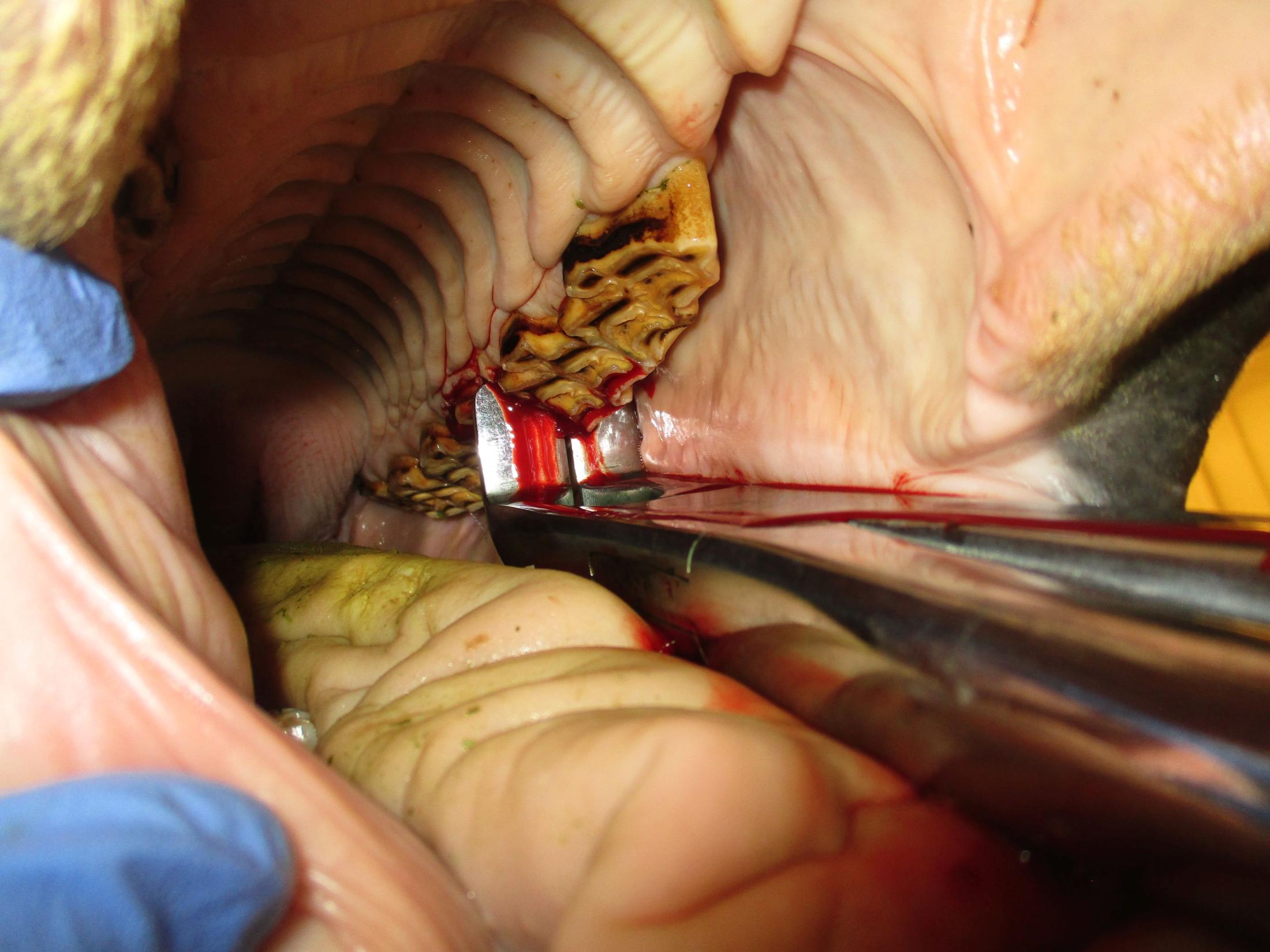 tooth extraction