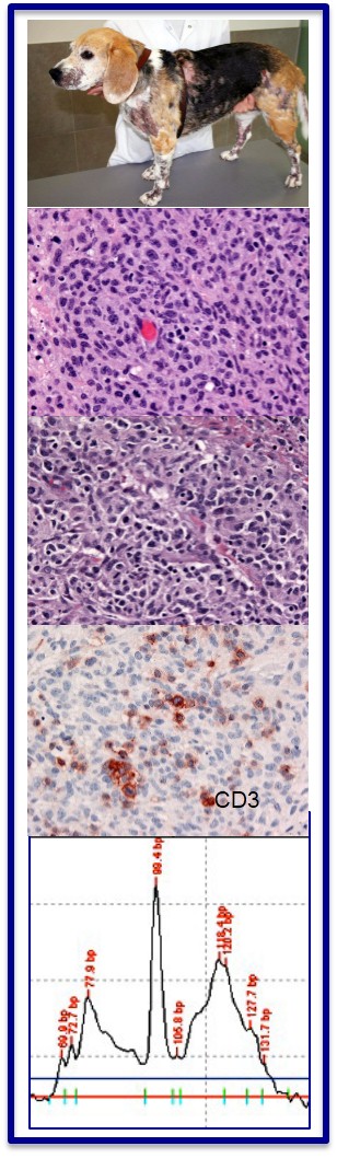 Morphologic features in association with atypical CD3+ T lymphocytes are suggestive of an inflamed T cell lymphoma. Clonality revealed a clonal rearrangement of the T cell receptor of lesions T lymphocytes, confirming the diagnosis of lymphoma.