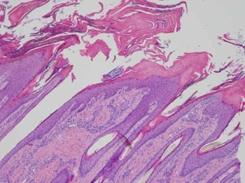 Dermatopathology: Cannon keratosis in a horse - marked superficial compact and parakertotic hyperkeratosis with extension into the follicular infundibula.