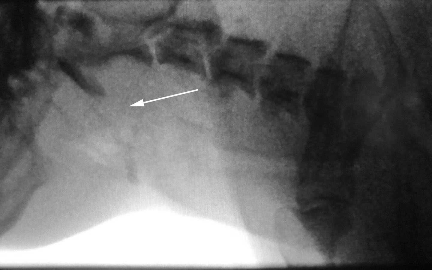 Pharynx collapsed