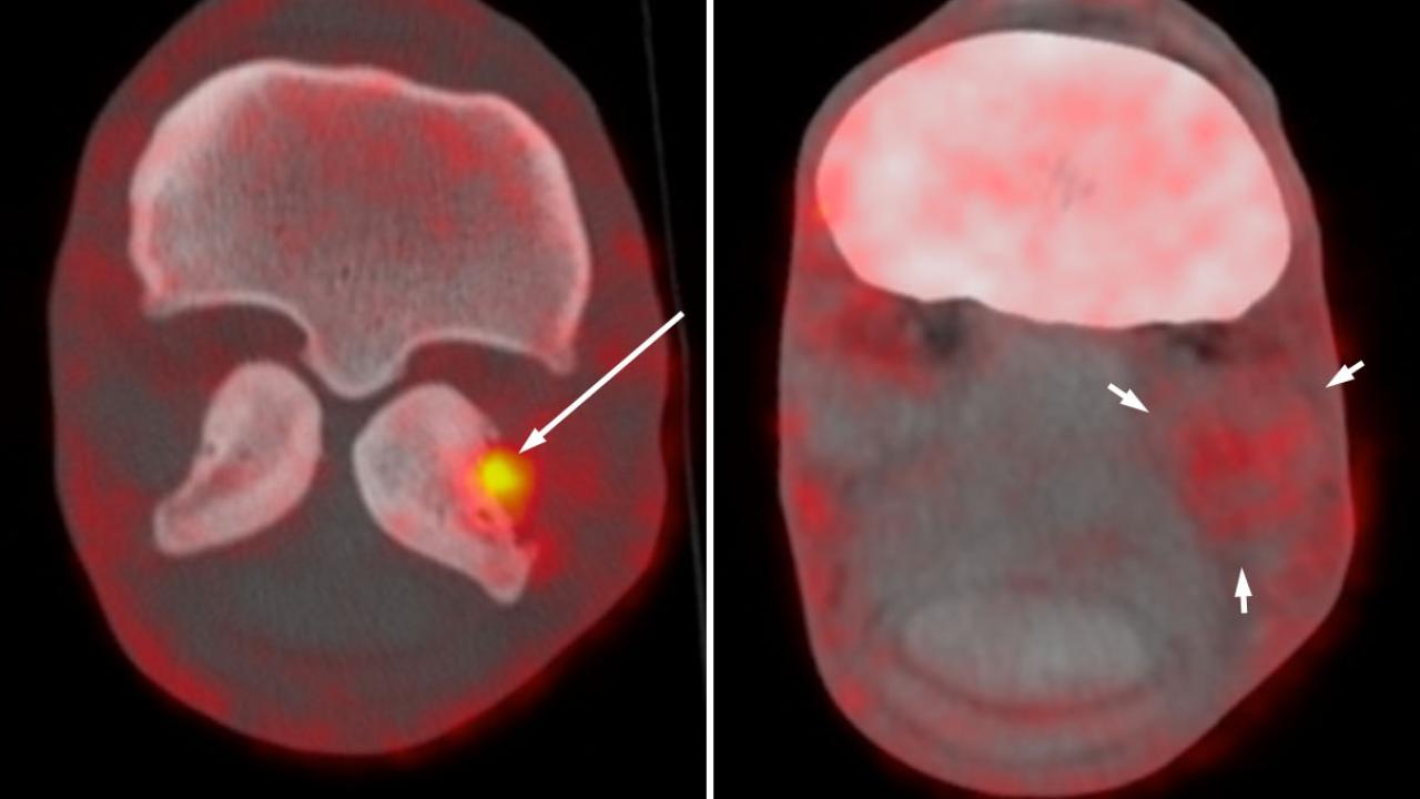 NaF PET and fused PET CT transverse images of the fetlock of a 6-year-old Warmblood horse.