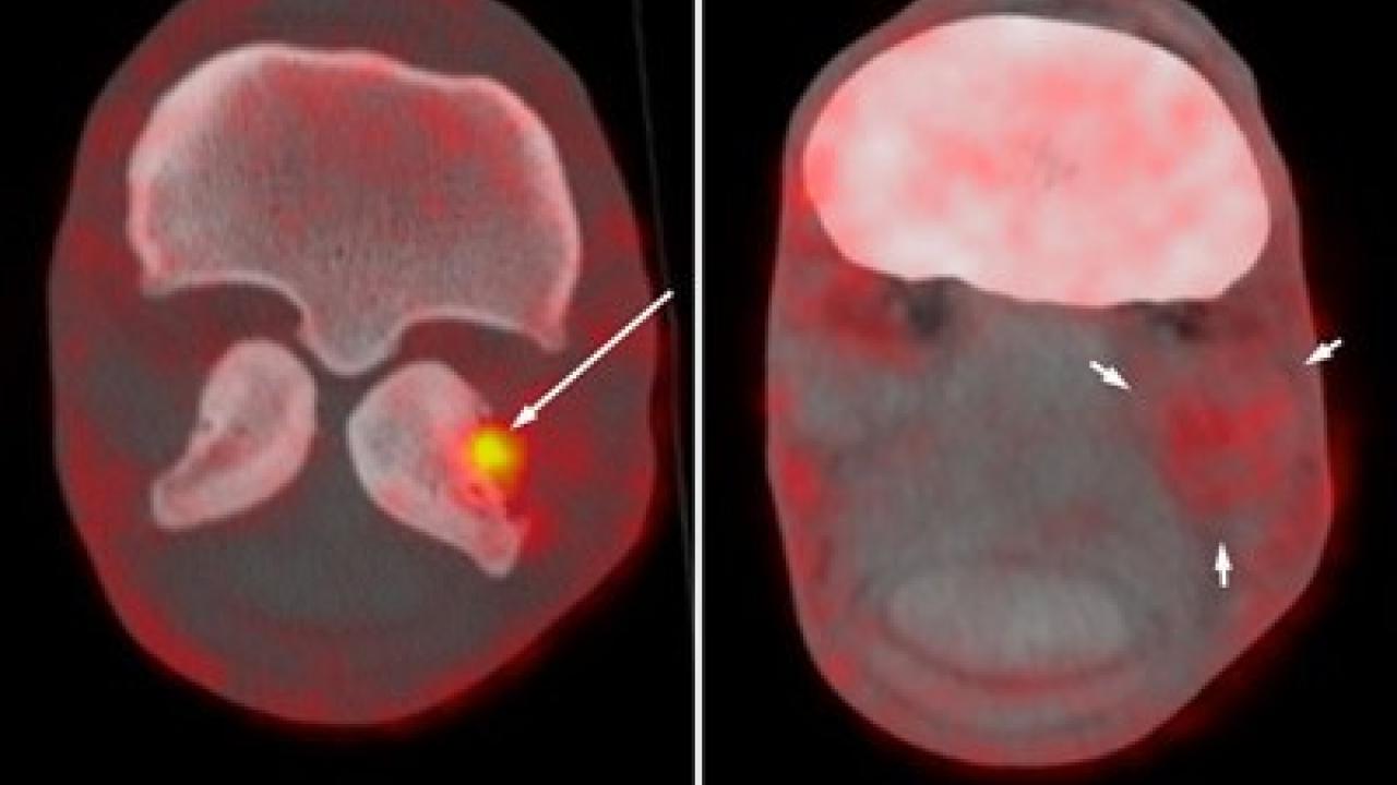 NaF PET and fused PET CT transverse images of the fetlock of a 6-year-old Warmblood horse.