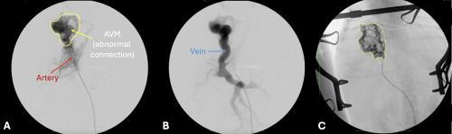 three fluoroscopy images showing a malformation of blood vessels