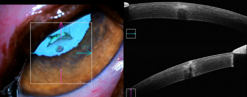 image showing foreign body in eye