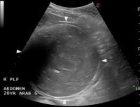 ultrasound image of distended intestine