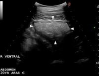 ultrasound image of normal intestine