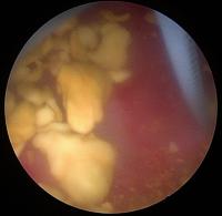 medical image of stone inside kidney